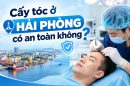 Cấy tóc ở Hải Phòng có an toàn không? 5 điều cần biết