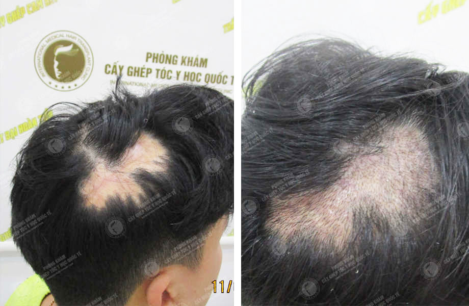 Cấy tóc che sẹo ở Hải Phòng có hiệu quả không?
