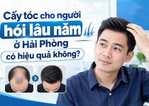 cấy tóc cho người hói lâu năm ở hải phòng có hiệu quả không