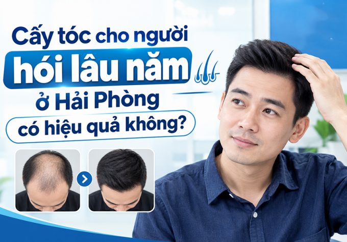 Cấy tóc cho người hói lâu năm ở Hải Phòng có hiệu quả không?