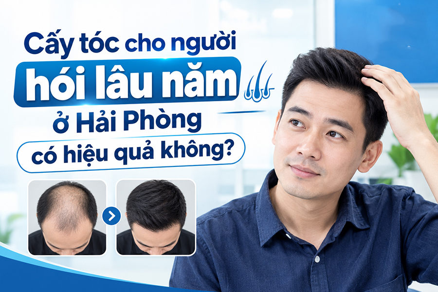 Cấy tóc cho người hói lâu năm ở Hải Phòng có hiệu quả không?
