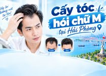 cấy tóc hói chữ m tại hải phòng