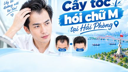 cấy tóc hói chữ m tại hải phòng