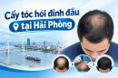 Cấy tóc hói đỉnh đầu tại Hải Phòng có tốt không? Lưu ý cần biết trước khi thực hiện