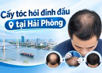 Cấy tóc hói đỉnh đầu tại Hải Phòng có tốt không