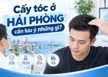 Cấy tóc ở Hải Phòng cần lưu ý những gì?