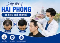 Cấy tóc ở Hải Phòng có hiệu quả không