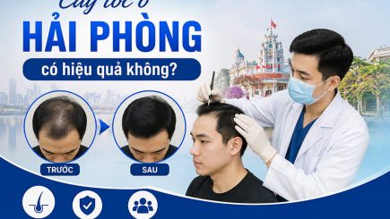 Cấy tóc ở Hải Phòng có hiệu quả không