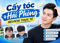 Cấy tóc Hải Phòng review thực tế: Đánh giá khách quan sau khi trải nghiệm?