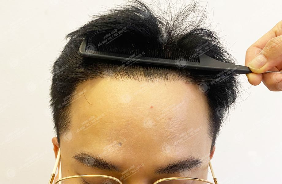 Cấy tóc Hải Phòng review thực tế: Đánh giá khách quan sau khi trải nghiệm?