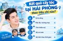 Đánh giá kết quả cấy tóc tại Hải Phòng theo tiêu chí nào? Trải nghiệm thực tế