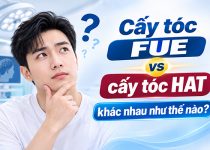 Cấy tóc FUE vs cấy tóc HAT khác nhau thế nào