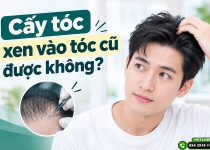 Cấy tóc xen vào tóc cũ được không