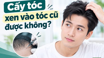 Cấy tóc xen vào tóc cũ được không
