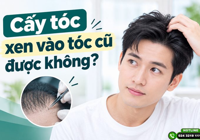 Cấy tóc xen vào tóc cũ được không? Khi nào nên làm, khi nào cần cân nhắc?