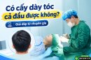 Có cấy dày tóc cả đầu được không? Giải đáp từ chuyên gia