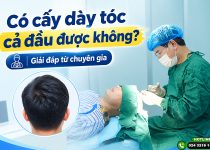 Có cấy dày tóc cả đầu được không? Giải đáp từ chuyên gia