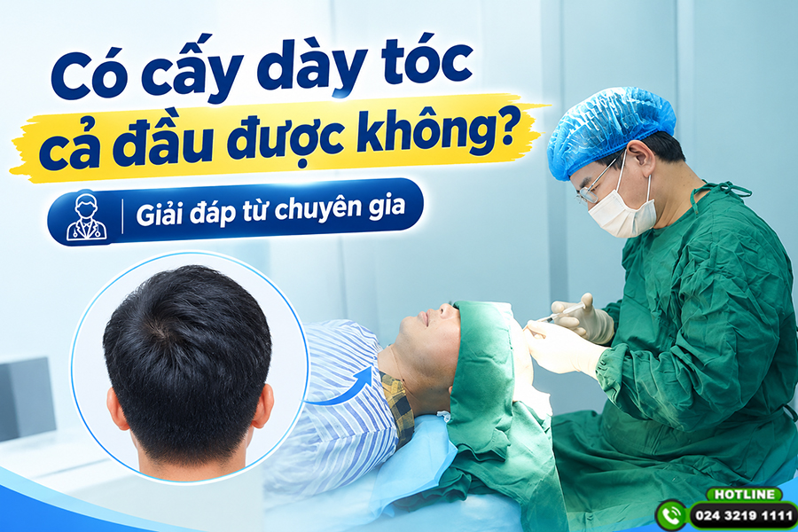 Có cấy dày tóc cả đầu được không? Giải đáp từ chuyên gia