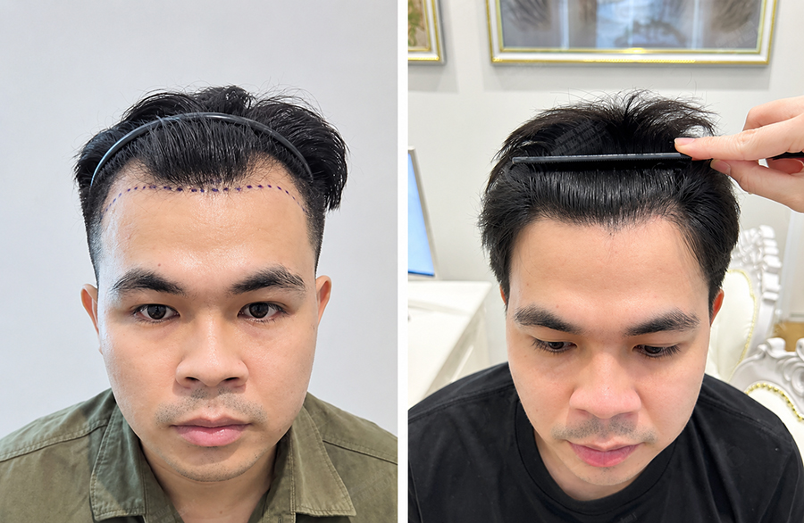 Hình ảnh trước sau khi cấy tóc hải phòng