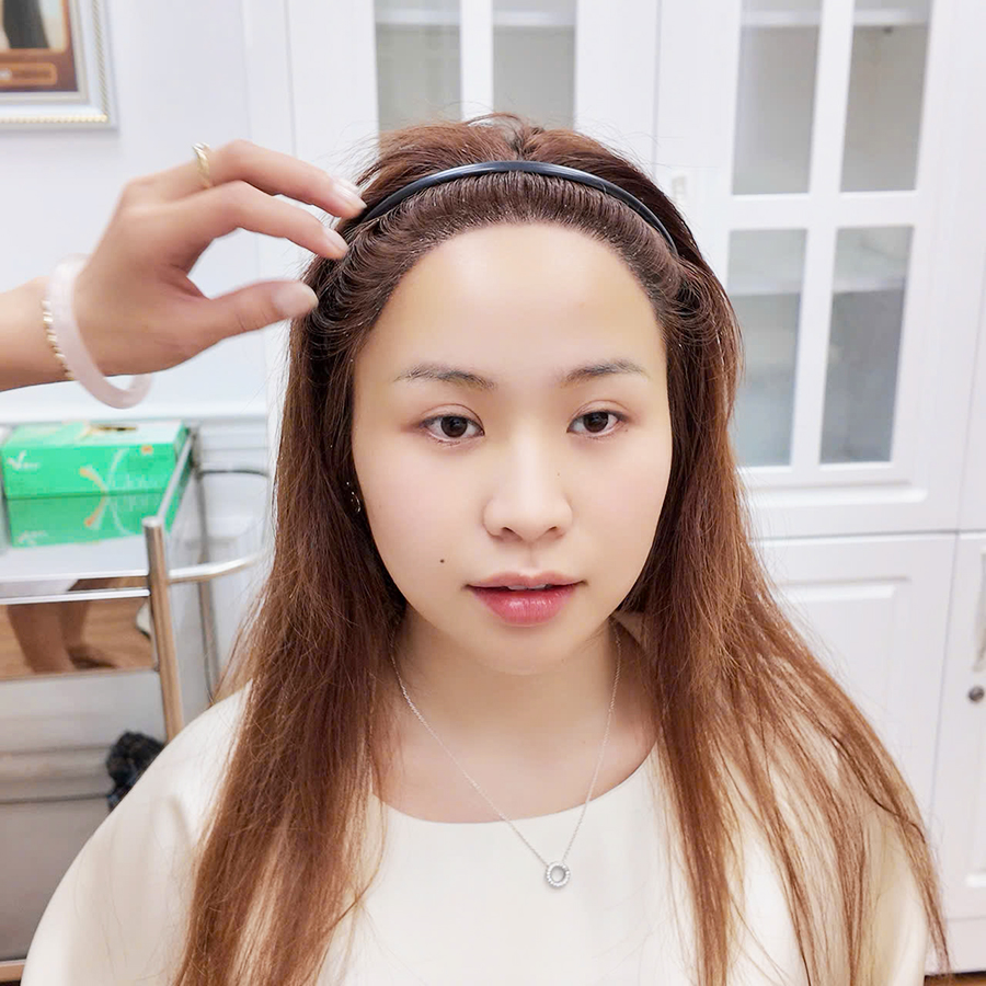 Hành trình cấy tóc tại Hải Phòng: ngày 10
