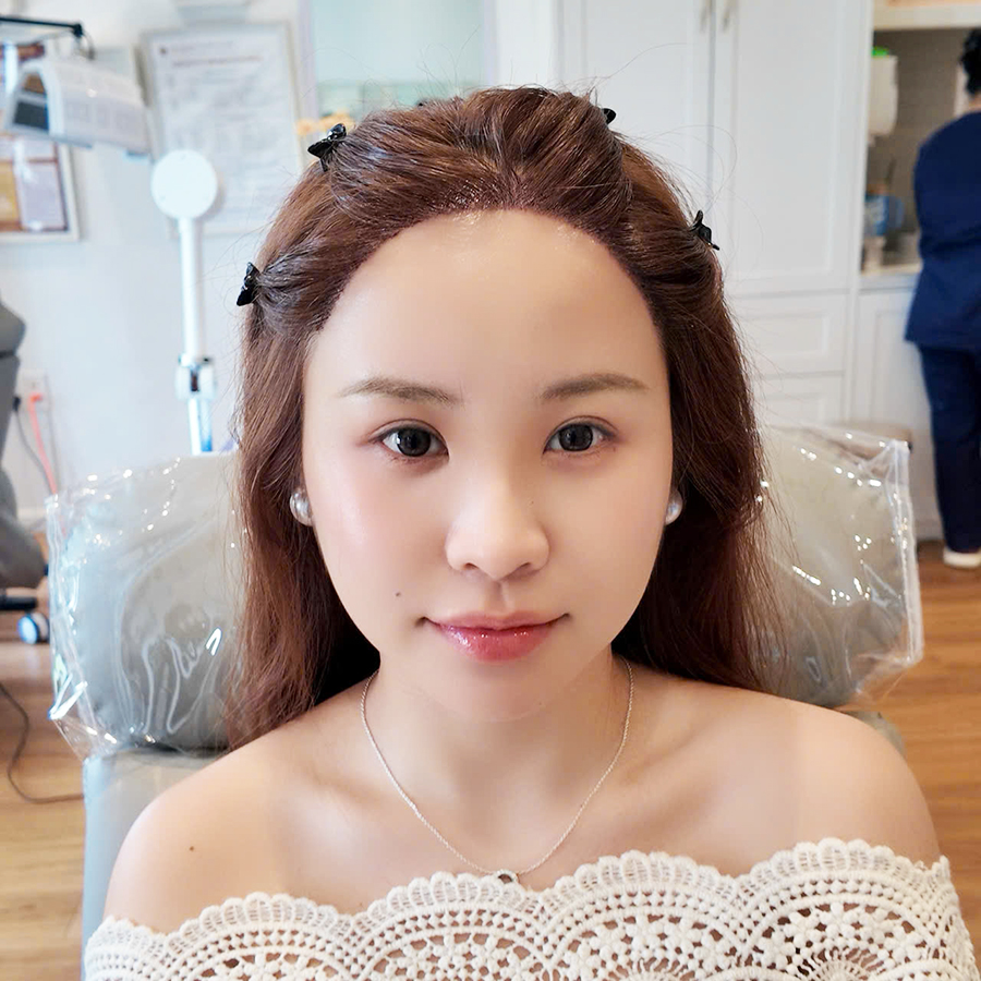 Hành trình cấy tóc tại Hải Phòng: ngày 2
