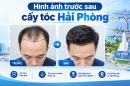 Hình ảnh trước sau cấy tóc Hải Phòng: Kiểm chứng hiệu quả thực tế