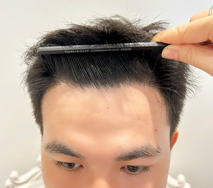 hình ảnh sau 1 năm cấy tóc