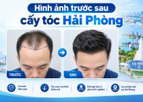 Hình ảnh trước sau khi cấy tóc hải phòng
