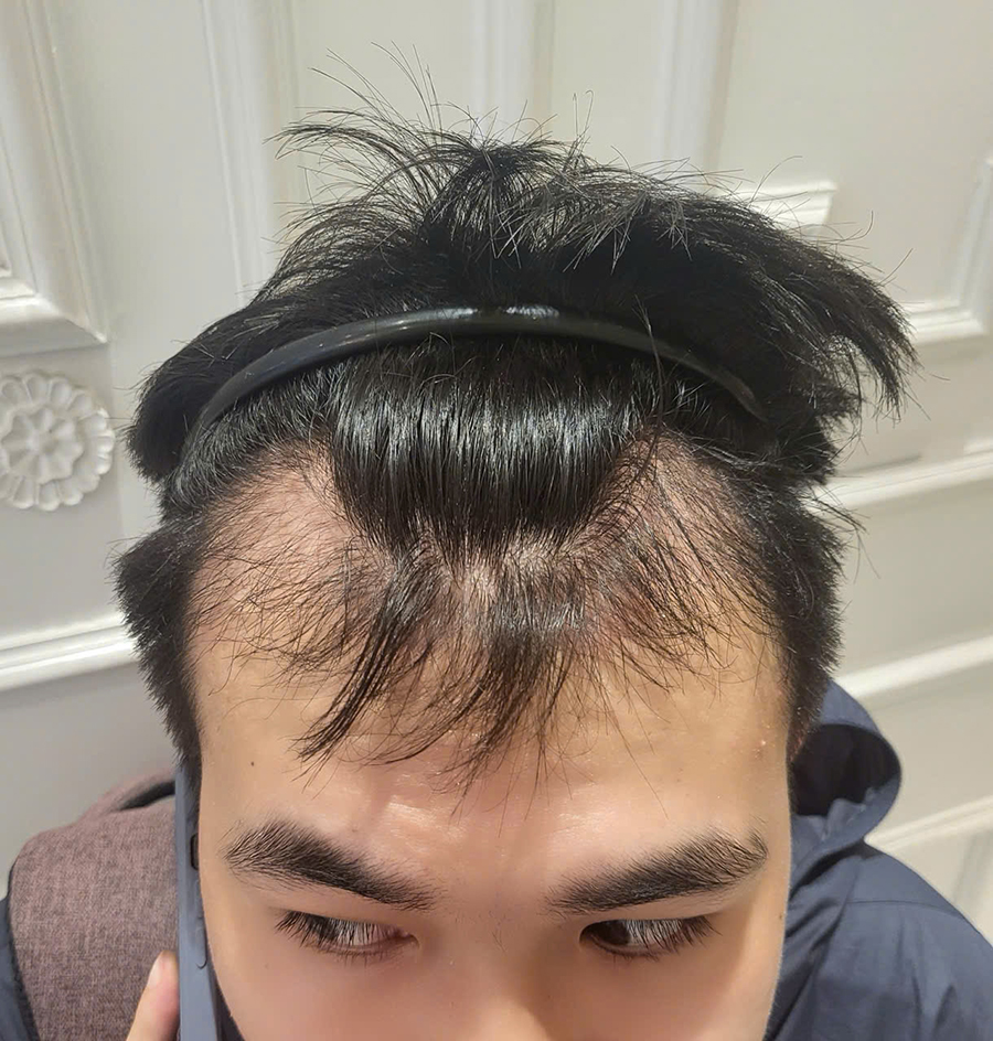 hình ảnh sau 3 tháng cấy tóc