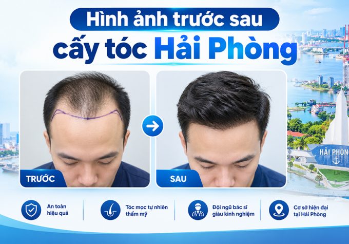 Hình ảnh trước sau cấy tóc Hải Phòng: Kiểm chứng hiệu quả thực tế