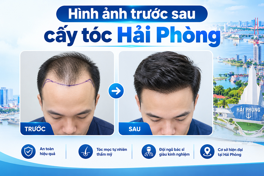 Hình ảnh trước sau cấy tóc Hải Phòng: Kiểm chứng hiệu quả thực tế