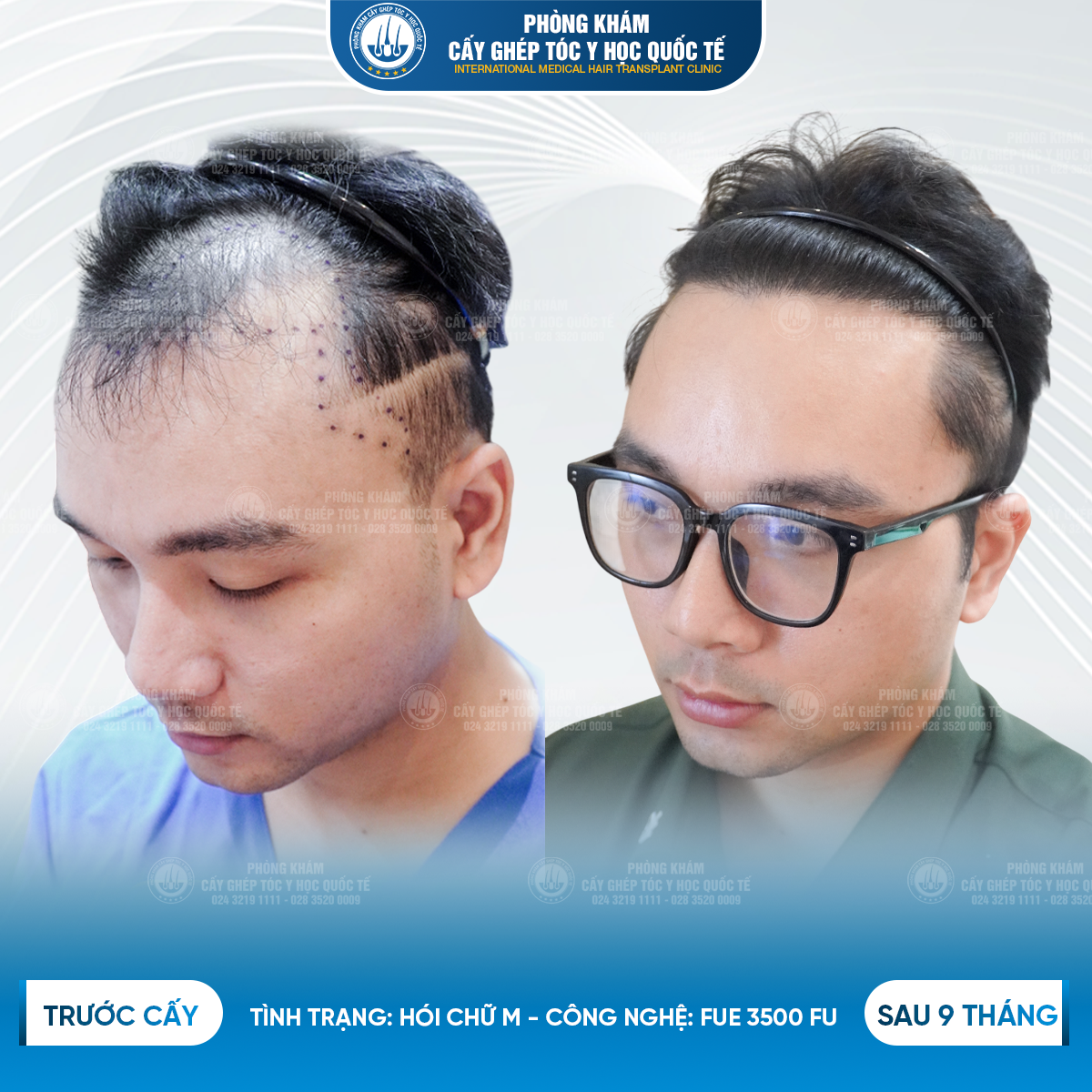 cấy tóc giá bao nhiêu