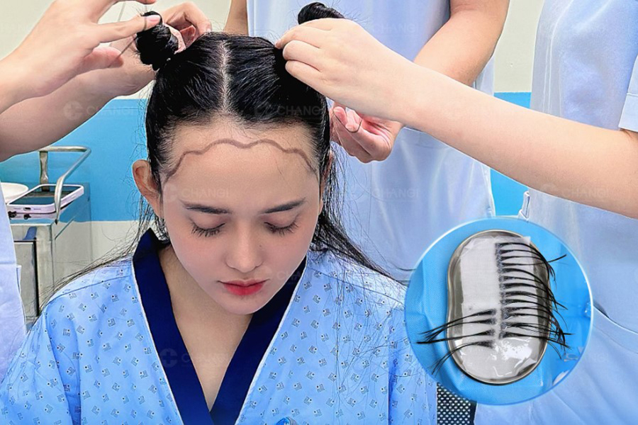 yếu tố cần cân nhắc trước khi quyết định cấy tóc tại Shanghai