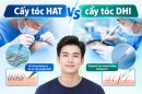Cấy tóc HAT vs cấy tóc DHI: Khác biệt nằm ở đâu và nên chọn phương pháp nào?