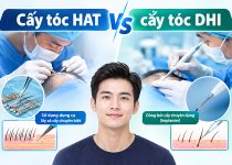 So sánh chi tiết phương pháp cấy tóc HAT vs cấy tóc DHI