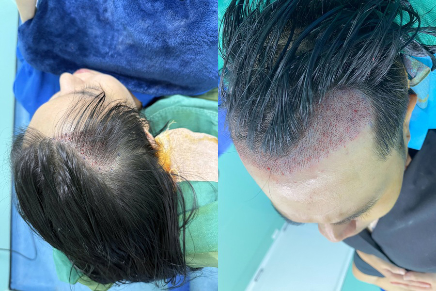 So sánh giá cấy tóc nang ngắn vs giá cấy tóc nang dài