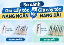 So sánh giá cấy tóc nang ngắn vs giá cấy tóc nang dài