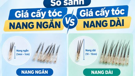 So sánh giá cấy tóc nang ngắn vs giá cấy tóc nang dài