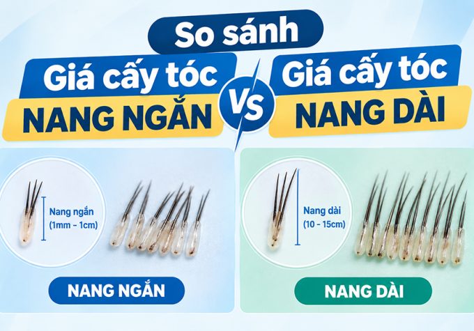 Giá cấy tóc nang ngắn vs giá cấy tóc nang dài: Chênh lệch bao nhiêu, nên chọn phương pháp nào?