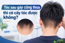 Tóc sau gáy cũng thưa thì có cấy tóc được không? Tư vấn từ chuyên gia