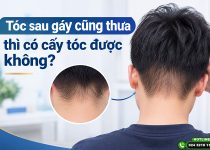 Tóc sau gáy cũng thưa thì có cấy tóc được không?