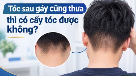 Tóc sau gáy cũng thưa thì có cấy tóc được không?