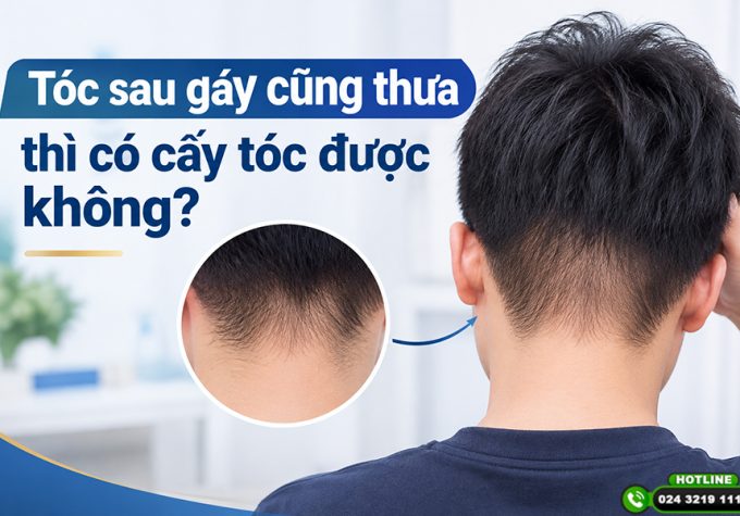 Tóc sau gáy cũng thưa thì có cấy tóc được không? Tư vấn từ chuyên gia