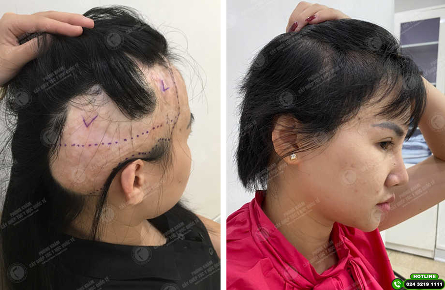 cấy tóc vào sẹo bỏng có được không