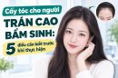 Cấy tóc cho người trán cao bẩm sinh: 5 điều cần biết trước khi thực hiện