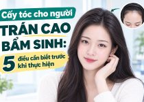 cấy tóc cho người trán cao bẩm sinh