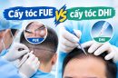 Cấy tóc FUE vs cấy tóc DHI: 5 điểm khác biệt có thể khiến bạn thay đổi lựa chọn