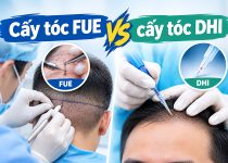 Cấy tóc FUE vs cấy tóc DHI