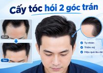 cấy tóc hói 2 bên góc trán