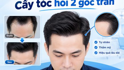 cấy tóc hói 2 bên góc trán